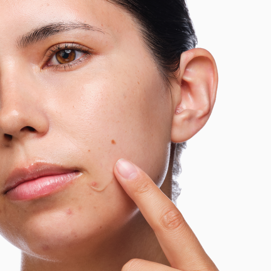 the-acne-set-h0 rdn-the-acne-set-application.png