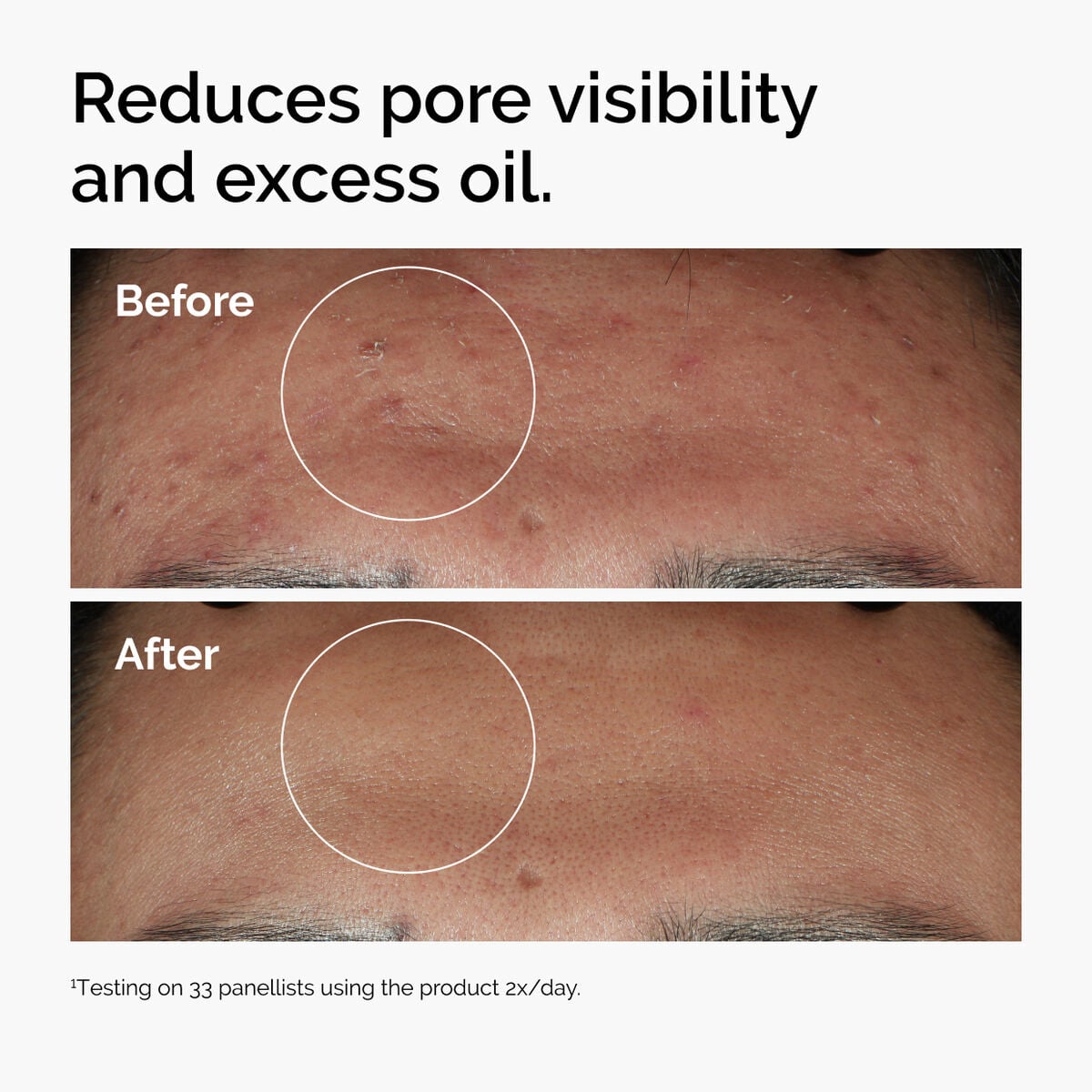 niacinamide-10-zinc-1-r4 ord-niacinamide-zinc-blemish-serum-before-after-pores.jpg