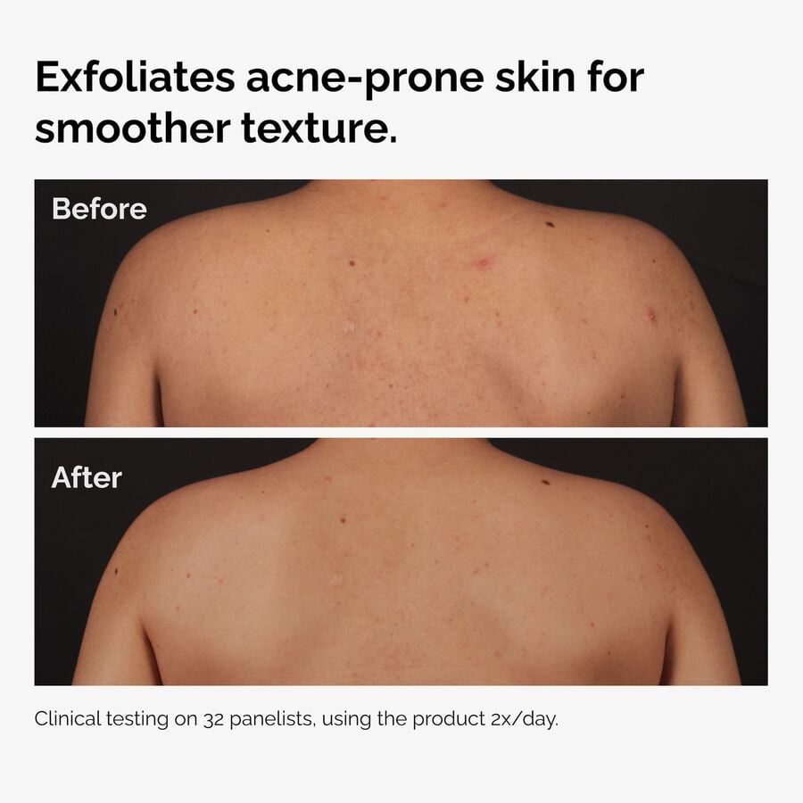 salicylic-acid-0-5-body-serum-y2 ord-salicylic-acid-body-serum-before-after-graphic-NA.jpg